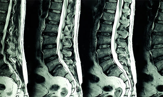 how to treat degenerative disc disease